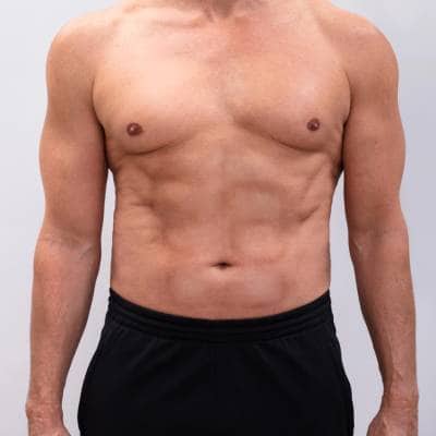Male Body Contouring
